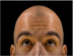 hair loss