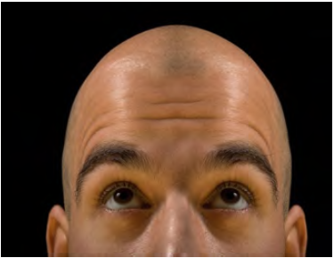 hair loss